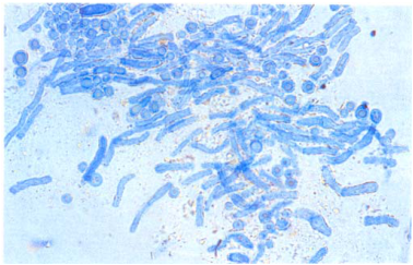  玫瑰糠疹( pityriasis rosea ) 變色糠疹( pityriasis versicolor )