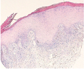  leukoplakia