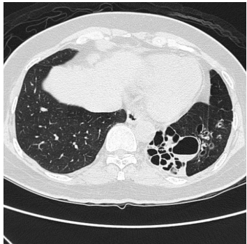  膿胸( empyema ) 空洞性肺癌( cystic lung carcinoma )