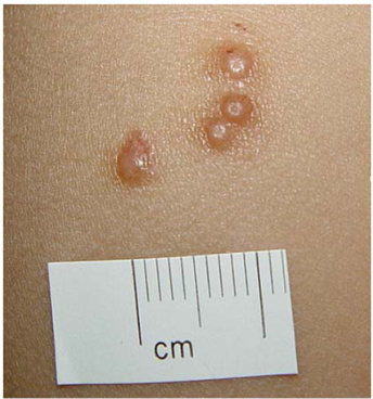  扁平疣( flat warts