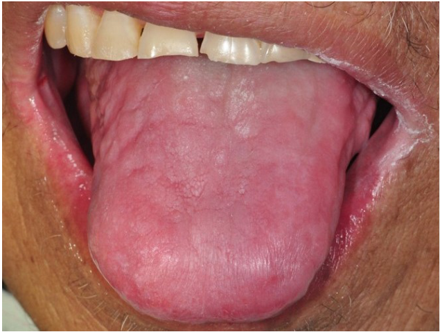 16. 關於霍奇金淋巴瘤( Hodgkin lymphoma )的敘述,下列何者正確?