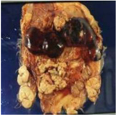 A. 鱗狀上皮細胞癌（ squamous cell carcinoma ）