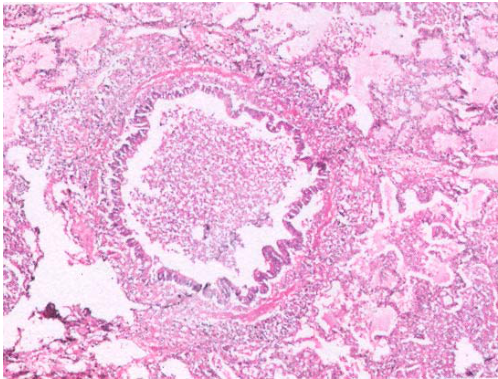  假單胞菌( Pseudomonus aeruginosa ) 厭氧菌( anaerobes )