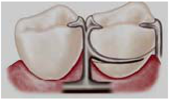  雙半牙鉤( half-and-half clasp ) 後作用牙鉤( back-action clasp