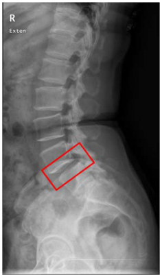  椎間盤突出症( HIVD ) 腰椎椎管狹窄症( Lumbar spinal stenosis ) 光片標示所示,下列敘述何者錯誤?