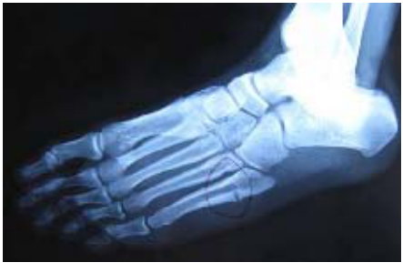  脊椎解離( Spondylolysis ) 脊椎滑脫( Spondylolisthesis )