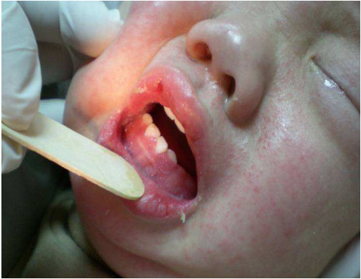 A.疱疹口腔炎(Herpetic gingivostomatitis)