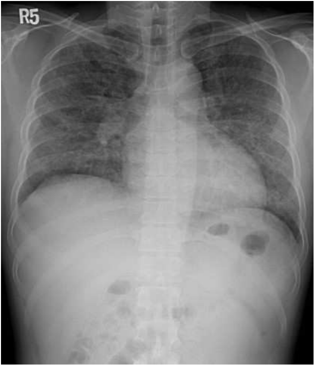 A. 除給予一般針對細菌的抗生素外,也需給予針對肺囊蟲( pneumocystis jirovecci )的抗生素