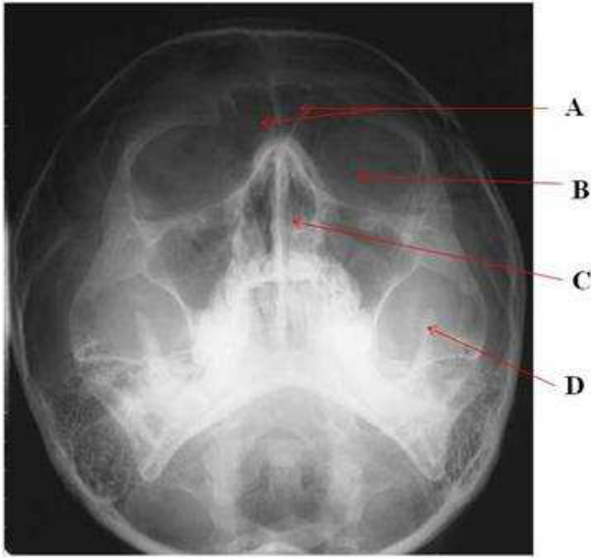 A.A : sphenoid sinus