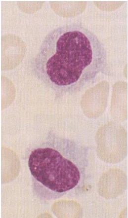  Adult T-cell leukemia/lymphoma Acute promyelocytic leukemia