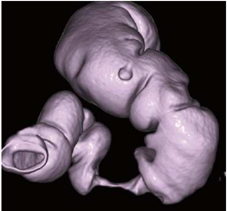 A.maximum intensity projection ( MIP )