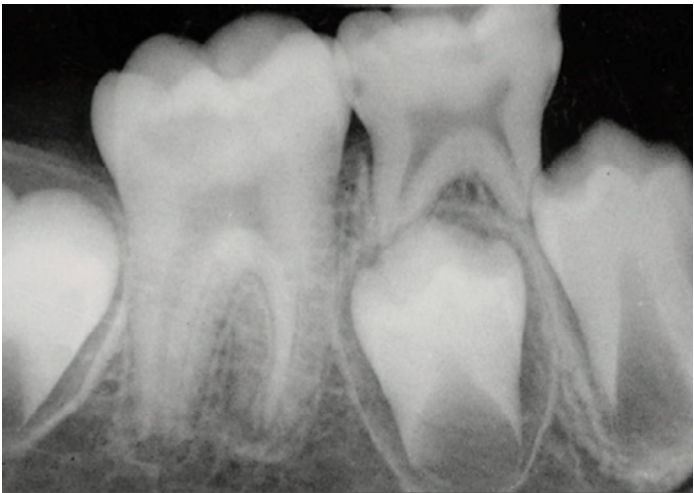 A.小心移除齲齒後、若無牙髓暴露，可採用間接覆髓法（indirect pulp therapy）治療