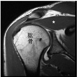  棘上肌( supraspinatus )