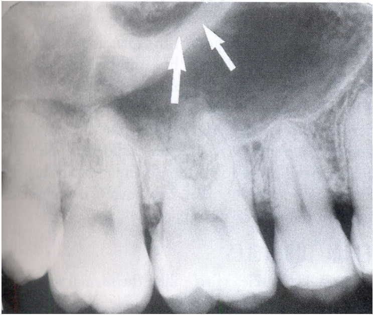A.zygomatic process of the maxilla