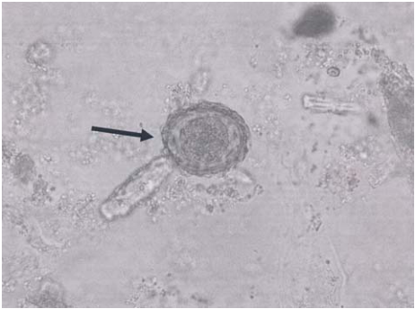 ）  惡性瘧原蟲（ Plasmodium falciparum ） ）  三日瘧原蟲（ Plasmodium malariae ） ，其為何種蟲卵？