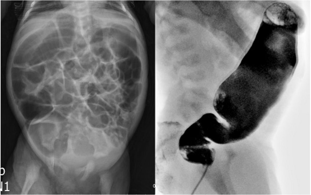 A.完成相關檢查後,留置肛管(rectal tube)或直腸灌洗(rectal irrigation)