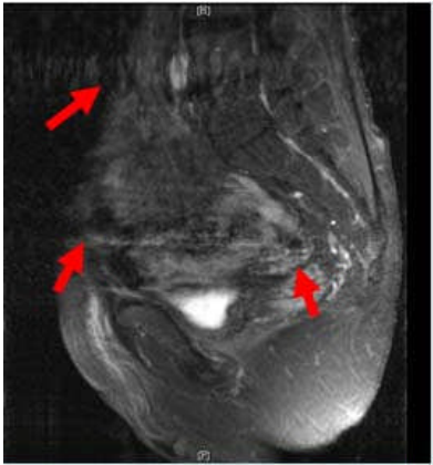 A. 增加激發次數( number of excitation ) B. 使用流動補償( flow compensation ) C. 調整相位 編碼方向( phase encoding direction ) D. 增加切面 厚度( slice thickness )
