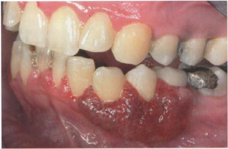 A. 魏格納肉芽腫症( Wegener granulomatosis )