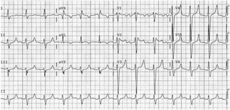 A. ⾼⾎鈉( hypernatremia )