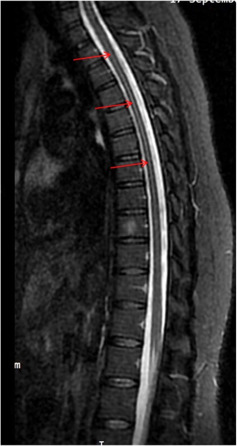 A.脊髓脫髓鞘(cord demyelination)