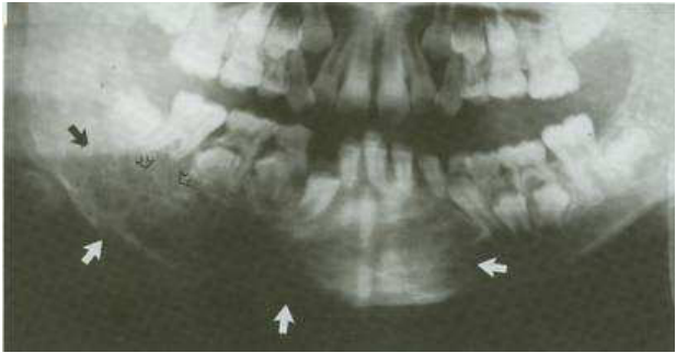 A. 纖維性發育不良( fibrous dysplasia )