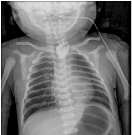 A. 該患兒必定伴隨著食道氣管瘻管( tracheoesophageal fistula )
