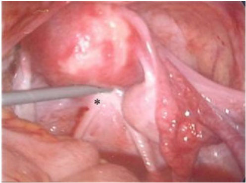 A.子宮薦椎韌帶(uterosacral ligament)
