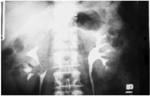 A.renal cell carcinoma
