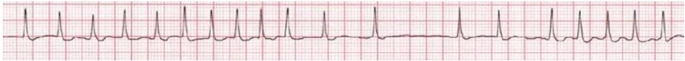A. 心房性纖維顫動( atrial fibrillation )