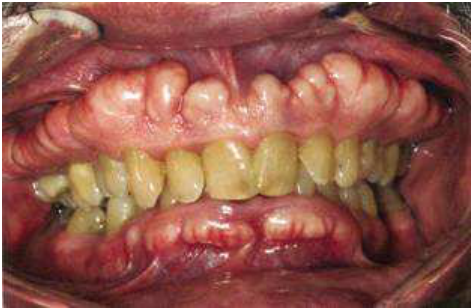 A.Buccal exostoses