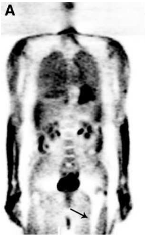 A.truncation artifacts B.respiration artifacts C.hip prosthesis D.tumor recurrence