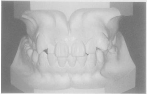  Class II, Division I Class III