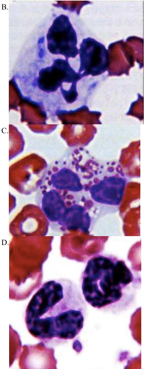 26. 下列何者不是白血病樣反應( leukemoid reaction )?