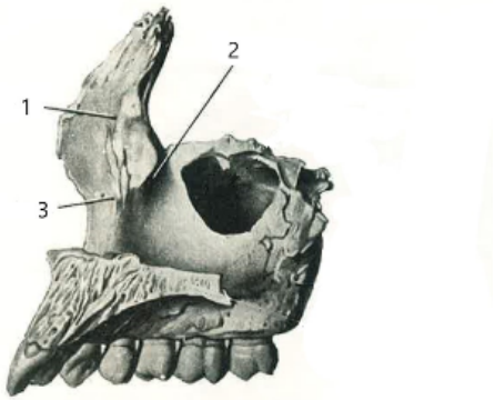 A. 篩骨嵴( ethmoid crest )、淚溝( lacrimal groove )、鼻甲嵴( conchal crest )