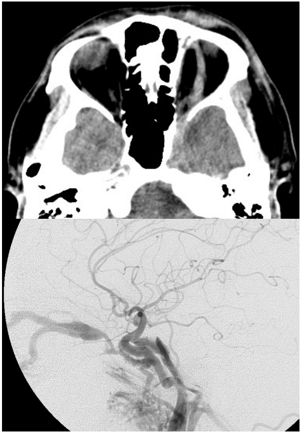 A. 直接型頸動脈 -海綿竇瘻管( direct carotid-cavernous fistula ),以放射治療即可痊癒
