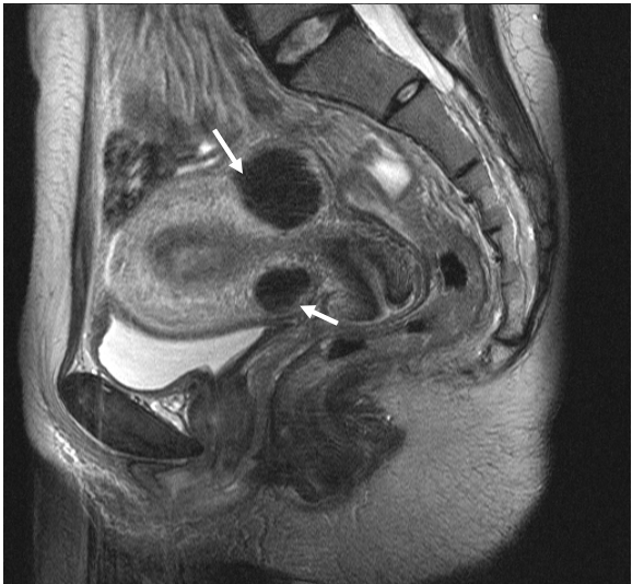  子宮內膜癌( endometrial carcinoma ) 子宮肌瘤( uterine myoma )