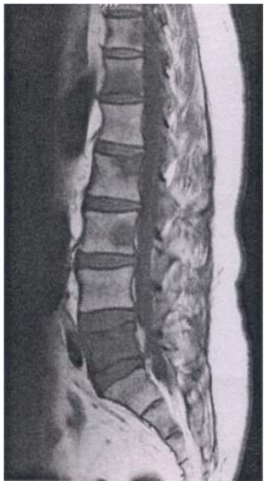  感染性脊椎炎( infectious spondylitis ) 退行性脊柱變化( degenerative spinal disease )