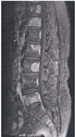  癌細胞骨轉移( bone metastasis ) 僵直性脊椎炎( ankylosing spondylitis )