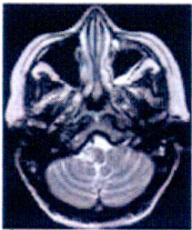  diffusion-weighted axial MRI