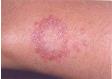  漢生病( leprosy; Hansen's disease ) 類肉瘤( sarcoidosis )