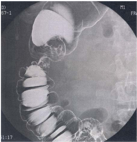  潰瘍性大腸炎( ulcerative colitis ) 克隆氏疾症( Crohn's disease )
