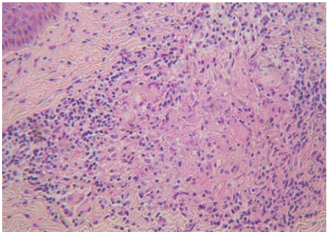  二期梅毒( secondary syphilis ) 孢子絲菌病( sporotrichosis )