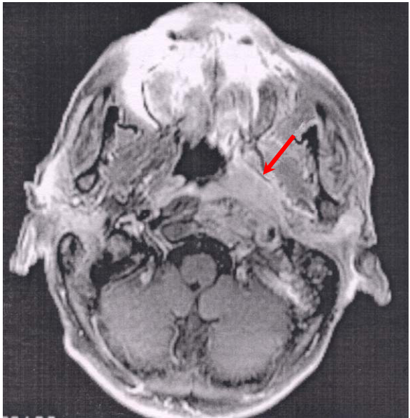 咽喉血管瘤( hemangioma in nasopharynx