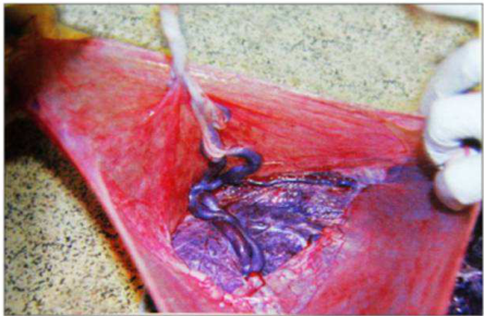 A.velamentous insertion