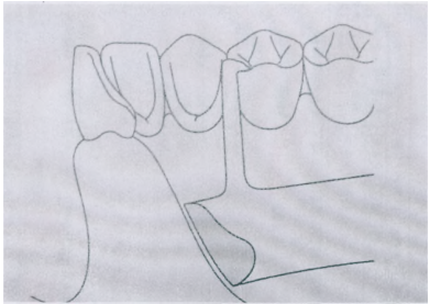  舌側板( lingual plate ) 唇側槓( labial bar )