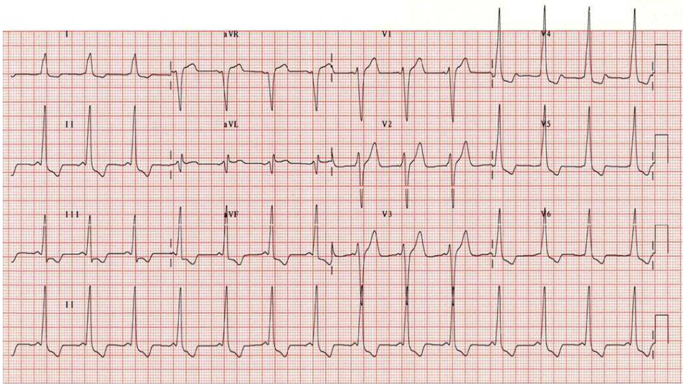 A.WPW 徵候群( Wolff-Parkinson-White syndrome )