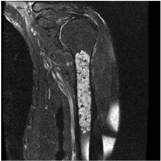  chondrosarcoma lymphoma 