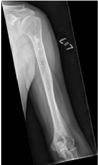 plasmacytoma  osteogenic sarcoma 