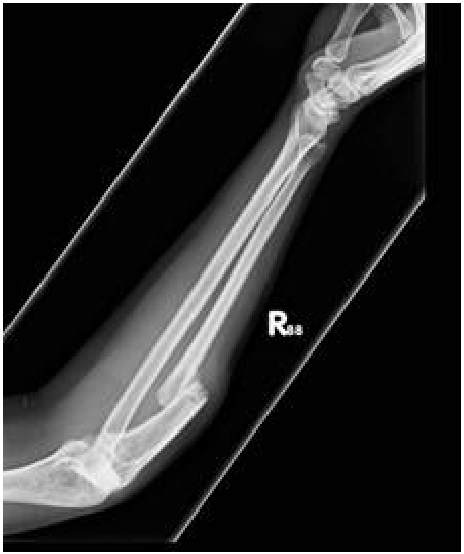 Monteggia fracture 