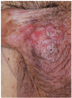  慢性濕疹（ chronic eczema ） ）